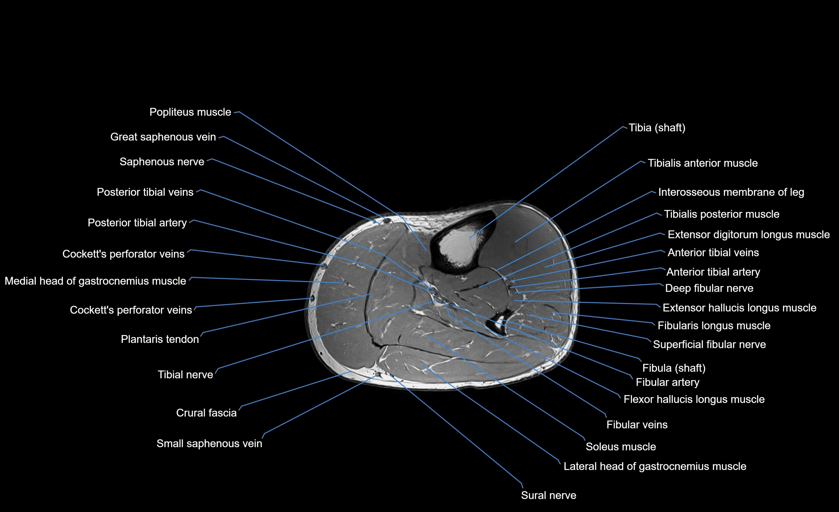 MRI lower leg axial cross sectional anatomy 3T  radiology  image-img-00001-00039.webp